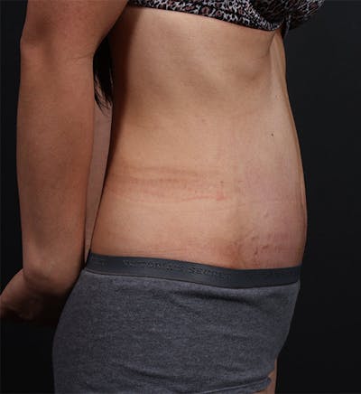 Hernia Rectus Diastasis Repair Before & After Gallery - Patient 14089733 - Image 6