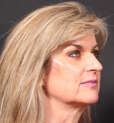 Injectables Before & After Gallery - Patient 14089736 - Image 10