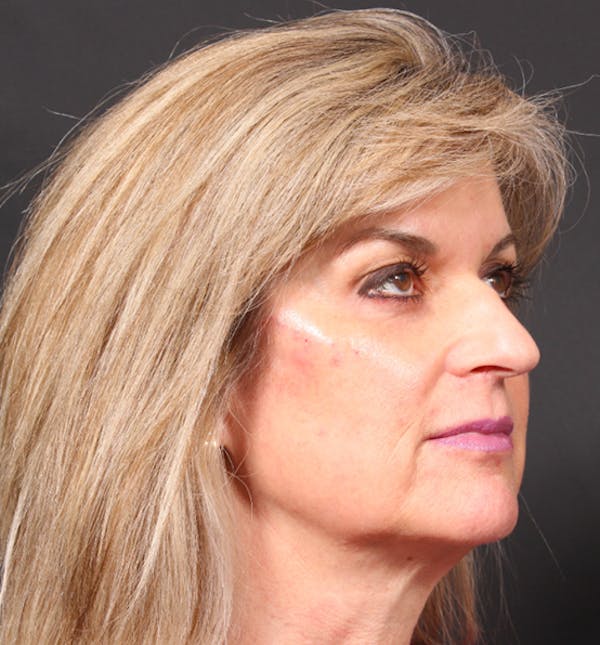 Injectables Before & After Gallery - Patient 14089736 - Image 10