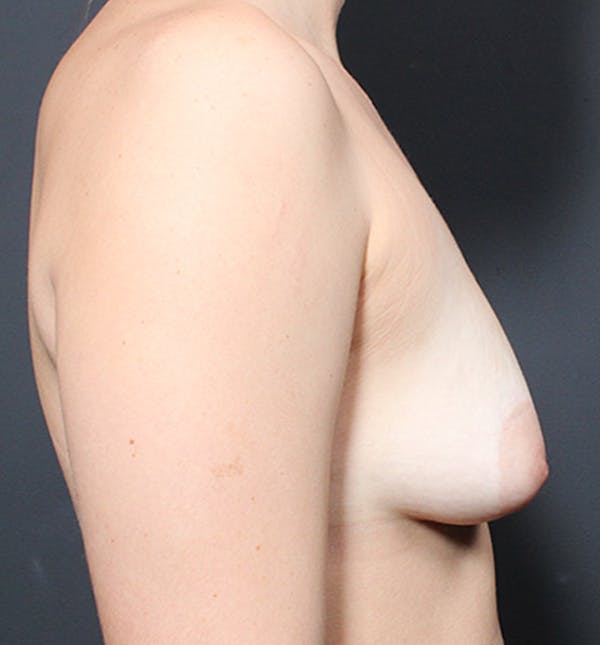 Breast Lift Mastopexy Before & After Gallery - Patient 14089738 - Image 9
