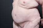 Hernia Rectus Diastasis Repair Before & After Gallery - Patient 14089742 - Image 2