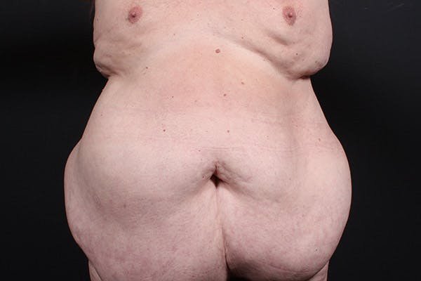 Hernia Rectus Diastasis Repair Before & After Gallery - Patient 14089742 - Image 3