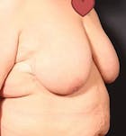 Breast Lift Mastopexy Before & After Gallery - Patient 14089747 - Image 1