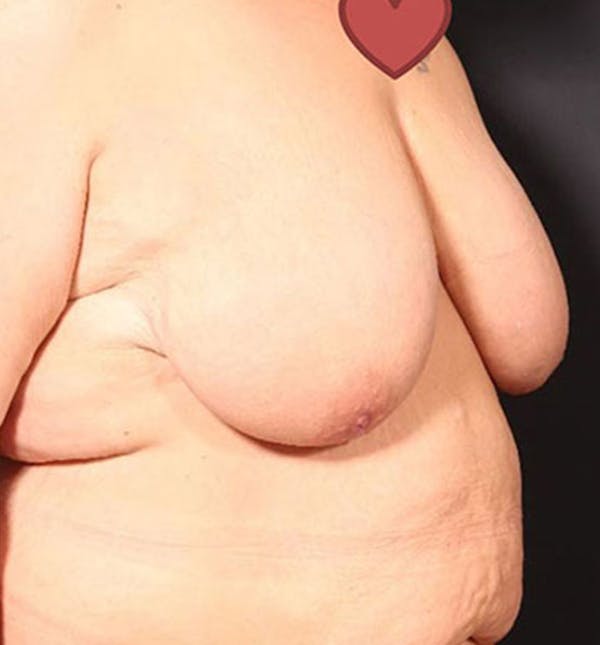 Breast Lift Mastopexy Before & After Gallery - Patient 14089747 - Image 1