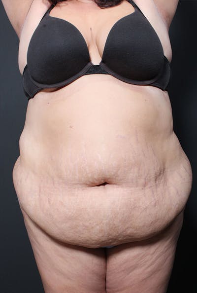 Plus Size Tummy Tuck® Before & After Gallery - Patient 14089748 - Image 1