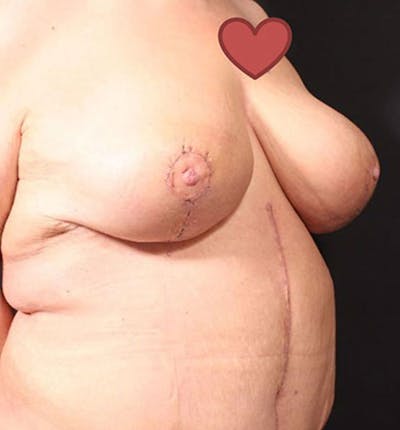 Breast Lift Mastopexy Before & After Gallery - Patient 14089747 - Image 2