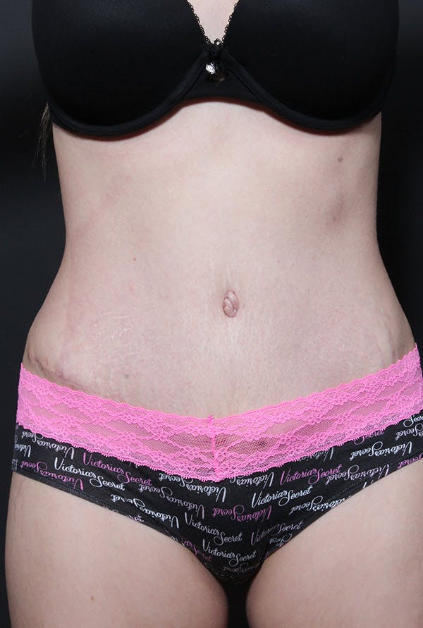 Liposuction Before & After Gallery - Patient 14089743 - Image 4