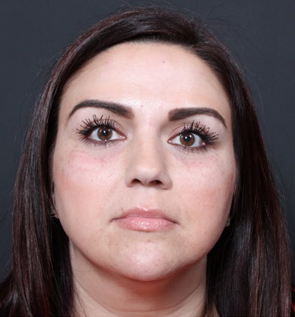 Injectables Before & After Gallery - Patient 14089750 - Image 4