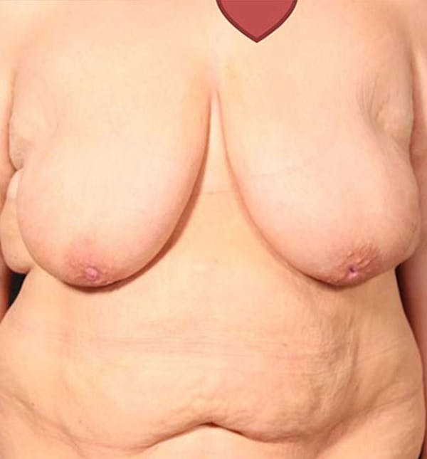 Breast Lift Mastopexy Before & After Gallery - Patient 14089747 - Image 3