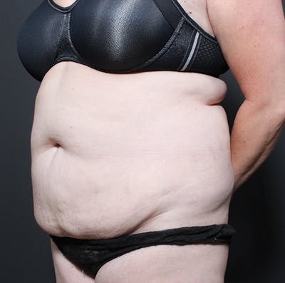 Liposuction Before & After Gallery - Patient 14089753 - Image 1