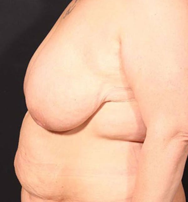 Breast Lift Mastopexy Before & After Gallery - Patient 14089747 - Image 7