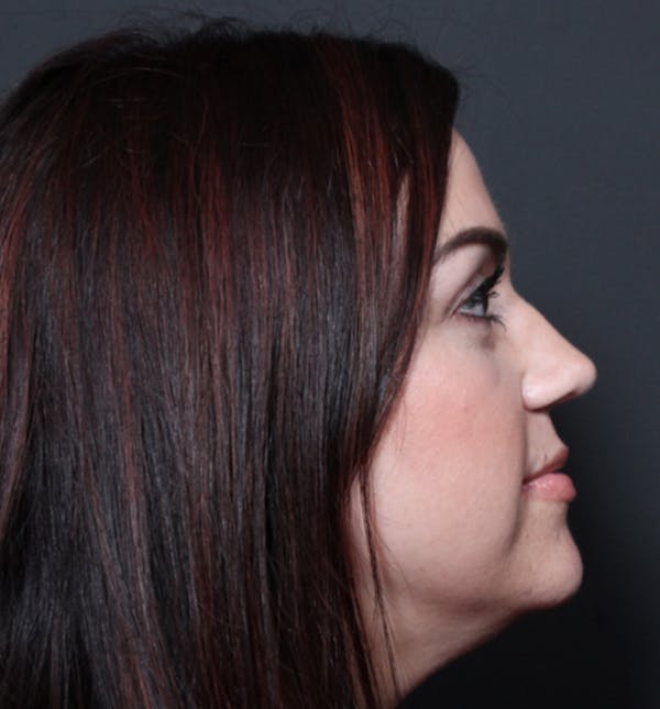 Injectables Before & After Gallery - Patient 14089750 - Image 7