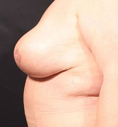 Breast Lift Mastopexy Before & After Gallery - Patient 14089747 - Image 8