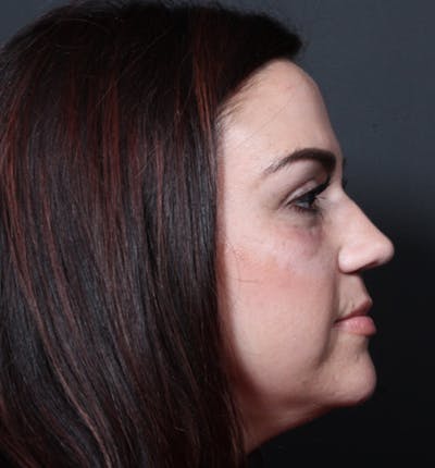 Injectables Before & After Gallery - Patient 14089750 - Image 8