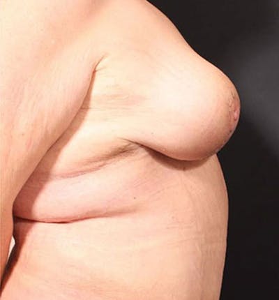 Breast Lift Mastopexy Before & After Gallery - Patient 14089747 - Image 10