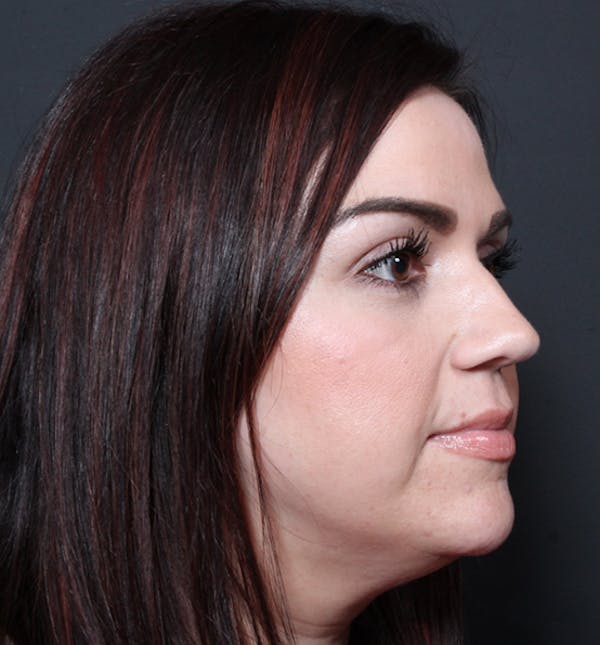 Injectables Before & After Gallery - Patient 14089750 - Image 9