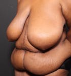Breast Lift Mastopexy Gallery - Patient 14089757 - Image 1