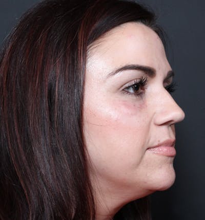 Injectables Before & After Gallery - Patient 14089750 - Image 10