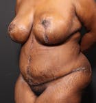 Breast Lift Mastopexy Before & After Gallery - Patient 14089757 - Image 2