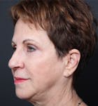 Injectables Before & After Gallery - Patient 14089760 - Image 1