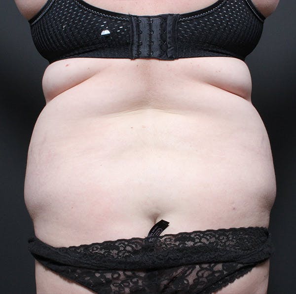 Liposuction Before & After Gallery - Patient 14089753 - Image 9