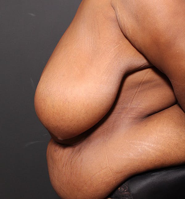 Breast Lift Mastopexy Gallery - Patient 14089757 - Image 5