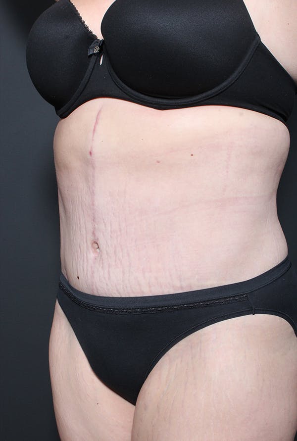 Hernia Rectus Diastasis Repair Before & After Gallery - Patient 14089758 - Image 2