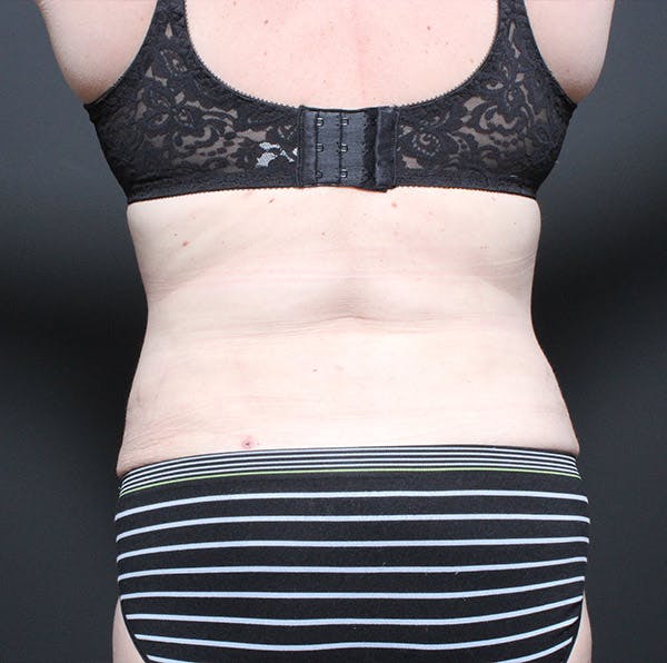 Liposuction Before & After Gallery - Patient 14089753 - Image 10
