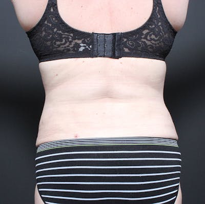 Liposuction Before & After Gallery - Patient 14089753 - Image 10