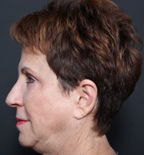 Injectables Before & After Gallery - Patient 14089760 - Image 5