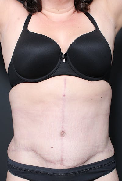 Hernia Rectus Diastasis Repair Before & After Gallery - Patient 14089758 - Image 4