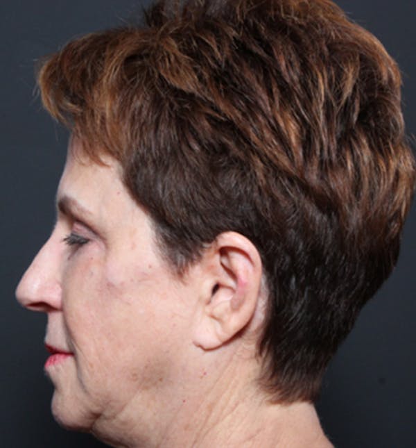 Injectables Before & After Gallery - Patient 14089760 - Image 6