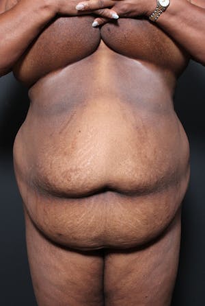 Plus Size Tummy Tuck