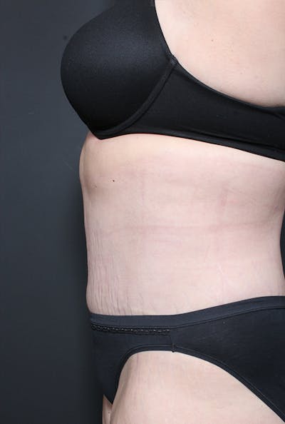 Hernia Rectus Diastasis Repair Before & After Gallery - Patient 14089758 - Image 6