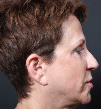 Injectables Gallery - Patient 14089760 - Image 8
