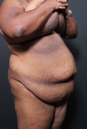 Plus Size Tummy Tuck