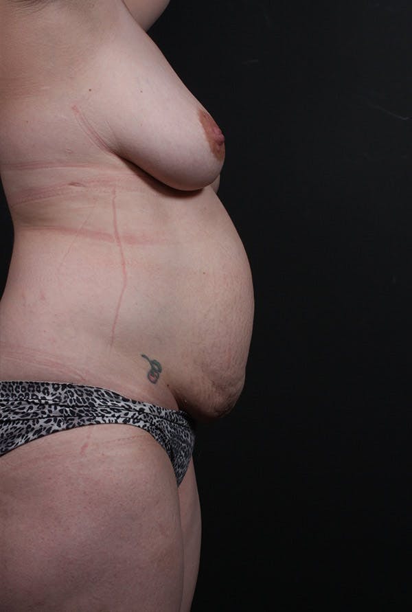 Liposuction Before & After Gallery - Patient 14089759 - Image 5