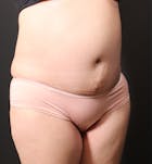 Hernia Rectus Diastasis Repair Before & After Gallery - Patient 14089771 - Image 2