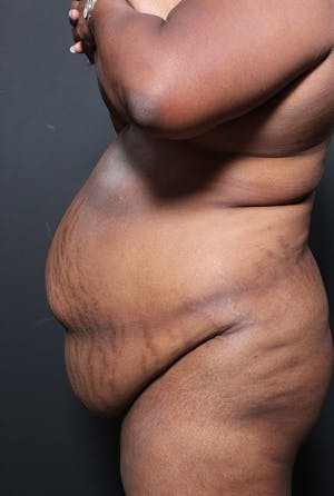 Plus Size Tummy Tuck