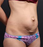 Liposuction Before & After Gallery - Patient 14089767 - Image 1