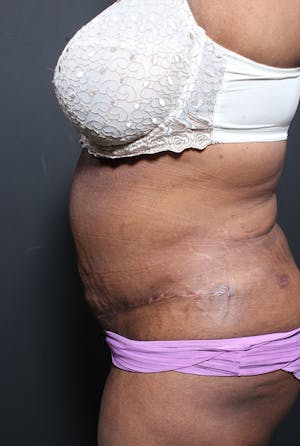 Plus Size Tummy Tuck