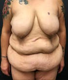 Plus Size Tummy Tuck® Gallery - Patient 14089765 - Image 1
