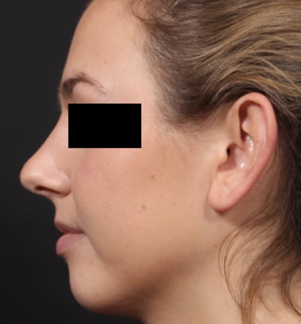Injectables Before & After Gallery - Patient 14089766 - Image 2