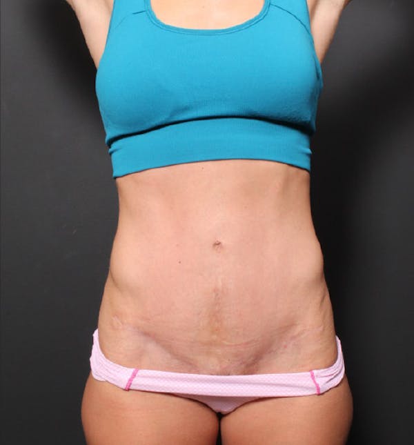 Hernia Rectus Diastasis Repair Before & After Gallery - Patient 14089777 - Image 4