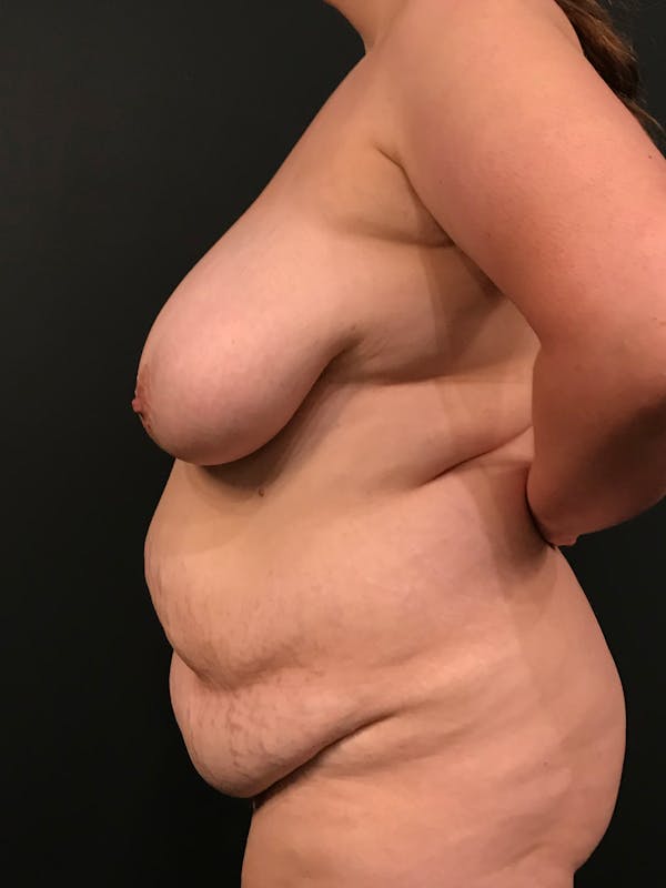 Plus Size Tummy Tuck® Before & After Gallery - Patient 14089776 - Image 5