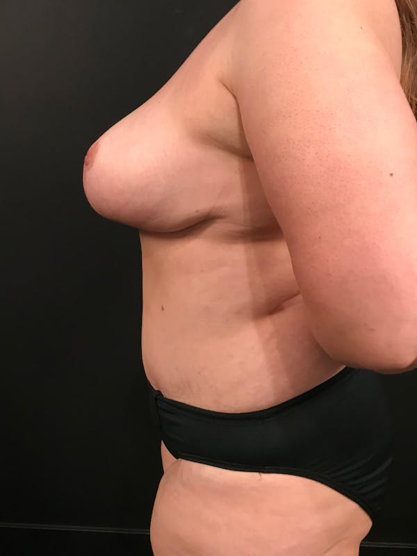 Plus Size Tummy Tuck® Before & After Gallery - Patient 14089776 - Image 6