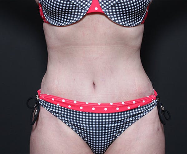 Liposuction Before & After Gallery - Patient 14089778 - Image 4