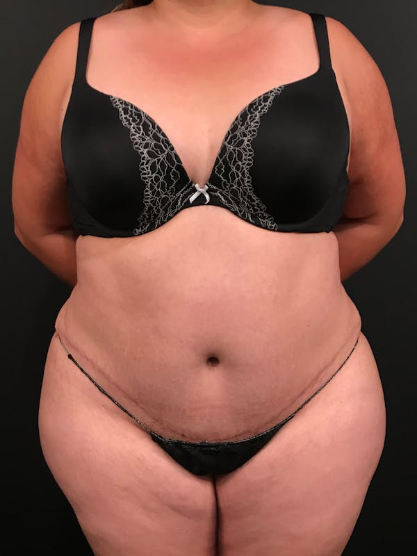 Plus Size Tummy Tuck® Before & After Gallery - Patient 14089780 - Image 2