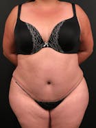 Plus Size Tummy Tuck® Gallery - Patient 14089780 - Image 2
