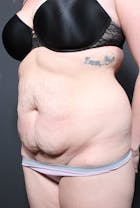 Liposuction Before & After Gallery - Patient 14089783 - Image 1